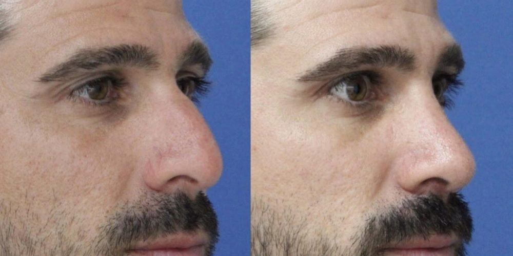 Functional Rhinoplasty